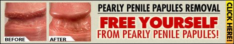 Pearly Papules Removal Review