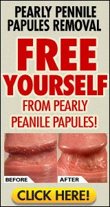 Pearly Papules Removal